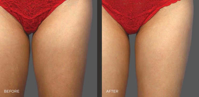 Thighs Before and After CoolSculpting Elite | Revive Med Spa In San Diego, CA