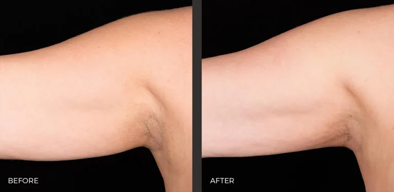 Upper Arms Before and After CoolSculpting Elite | Revive Med Spa In San Diego, CA