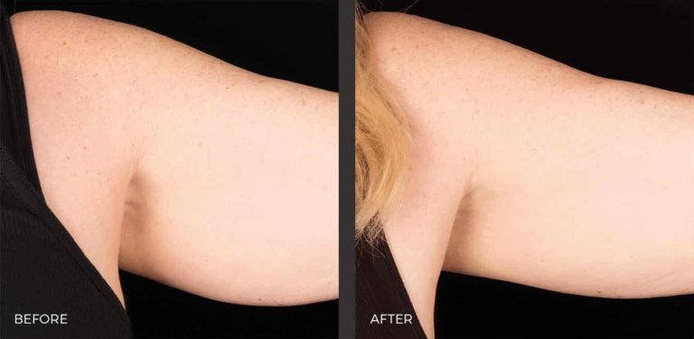 Upper Arms Before and After CoolSculpting Elite | Revive Med Spa In San Diego, CA