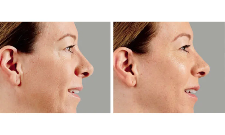 Voluma Before and After Cosmetic Treatment In San Diego, CA