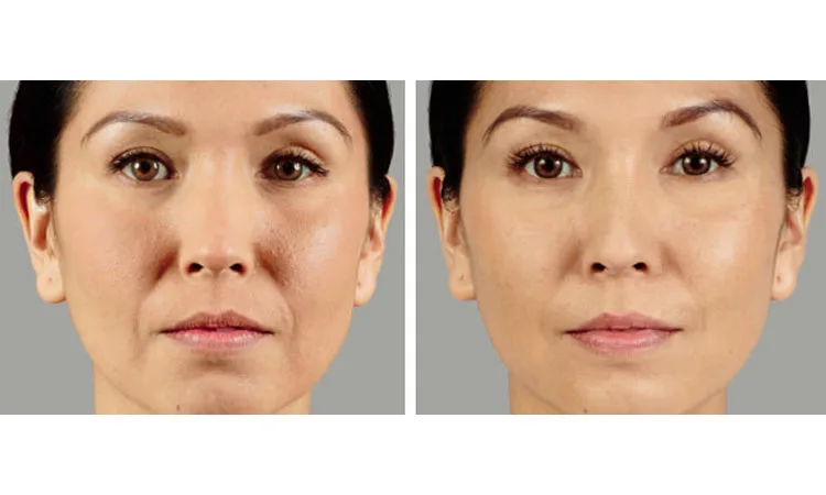 Voluma Before and After Cosmetic Treatment In San Diego, CA