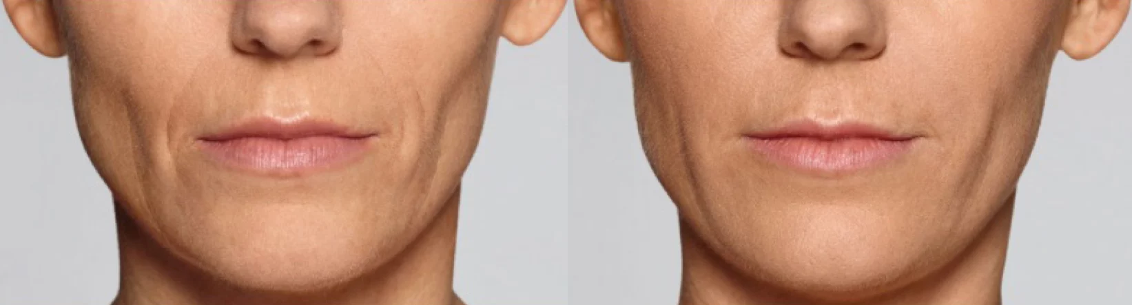 Restylane Contour Before And After-Five Revive Med Spa