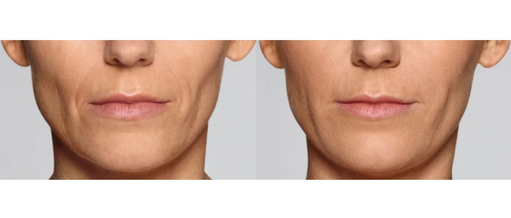Restylane Defyne Before and After-Three Revive Med Spa