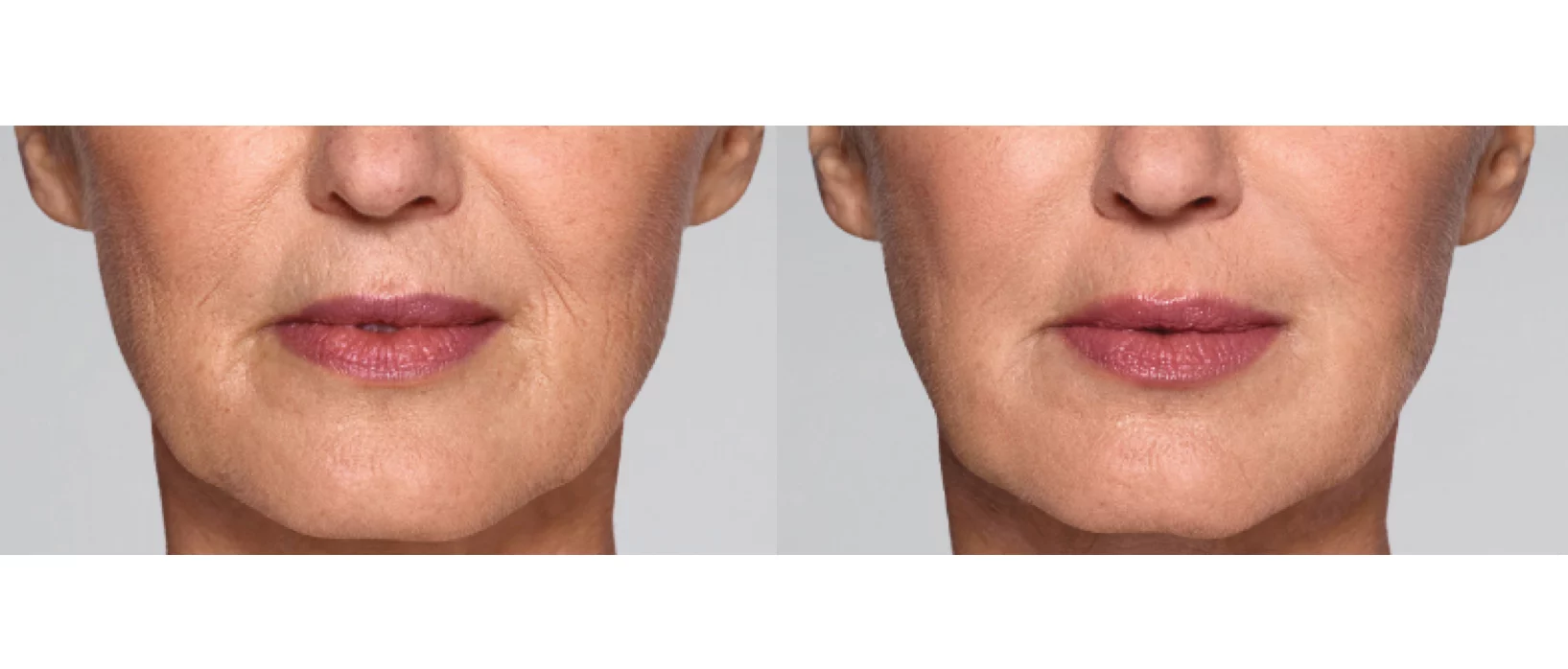 Restylane Refyne Lip fillers before and after revive med spa