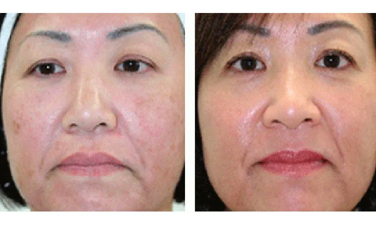 Photofacial Treatments Before and After Result 2 | Revive MedSpa In San Diego