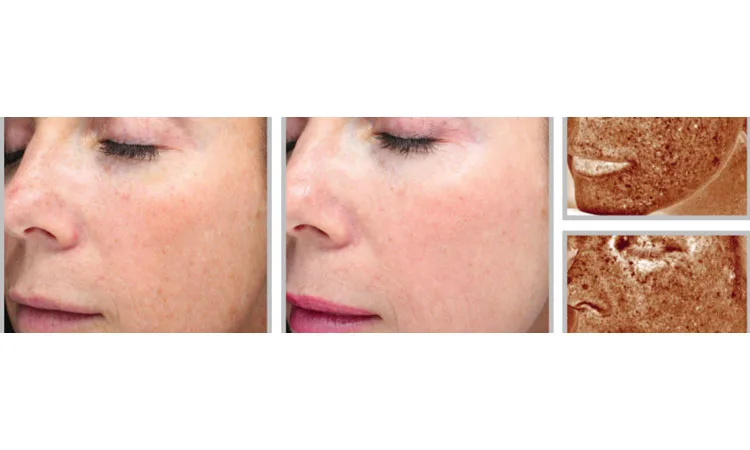 Halo skin treatment before and after | Revive MedSpa In San Diego