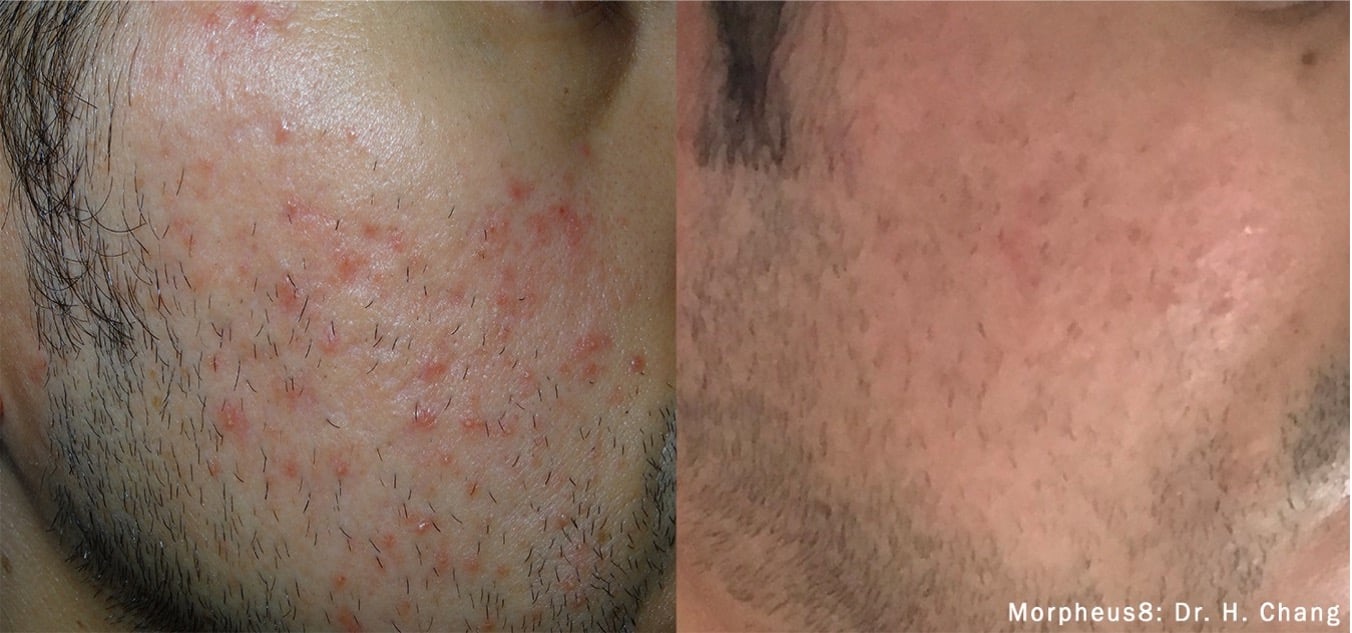 Before and after morpheus8 treatment san diego and encinitas