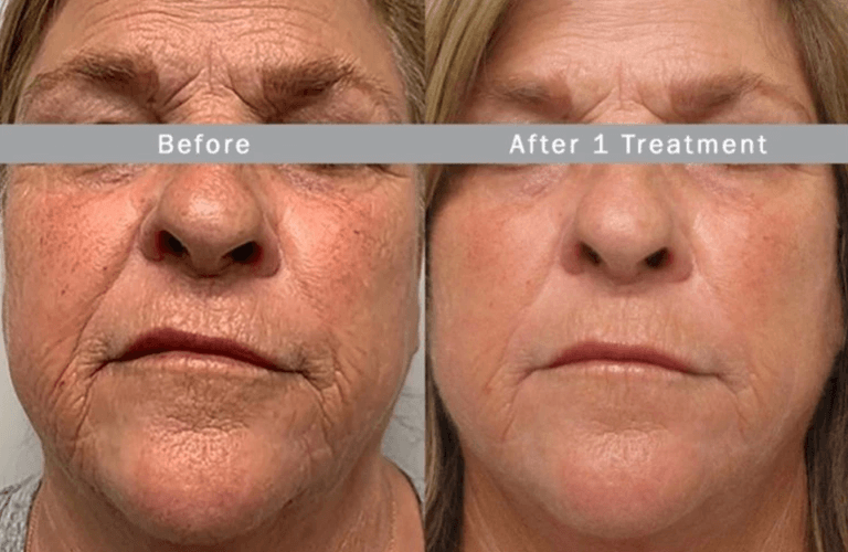 Before and after image - anti wrinkle treatment