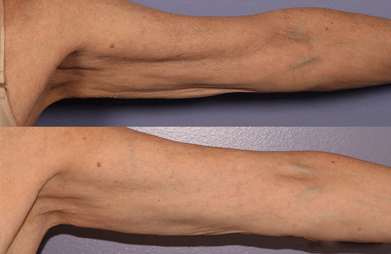 Before and after image - Skin tightening treatment San Diego