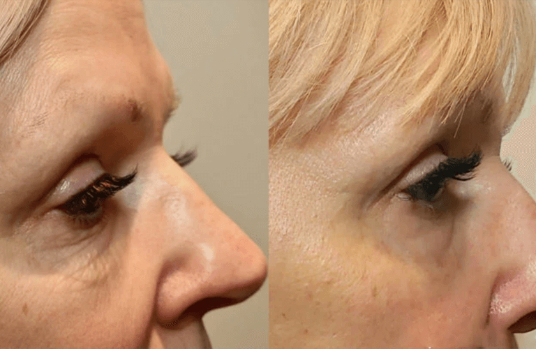 Before and after image - Skin tightening treatment San Diego