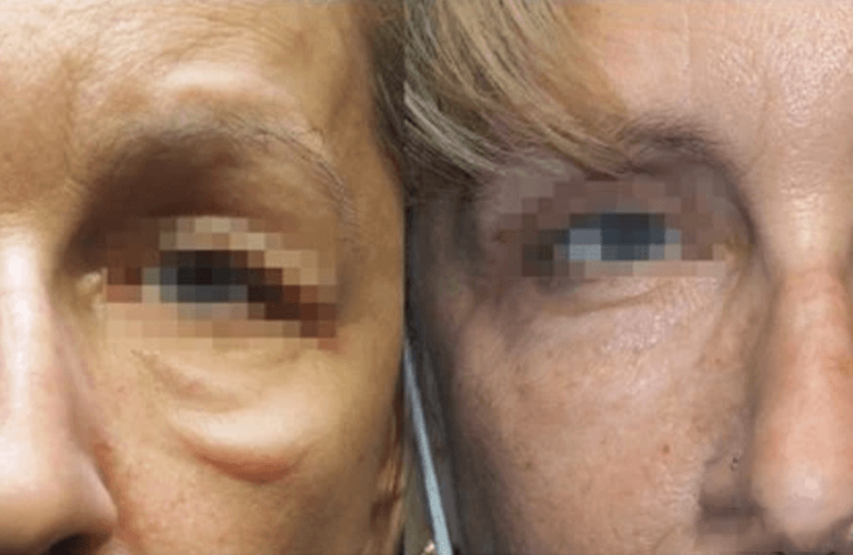Before and after image - Skin tightening/lifting treatment San Diego