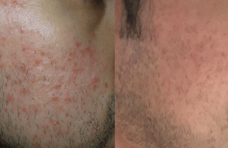 Before and after image - Skin Acne treatment San Diego