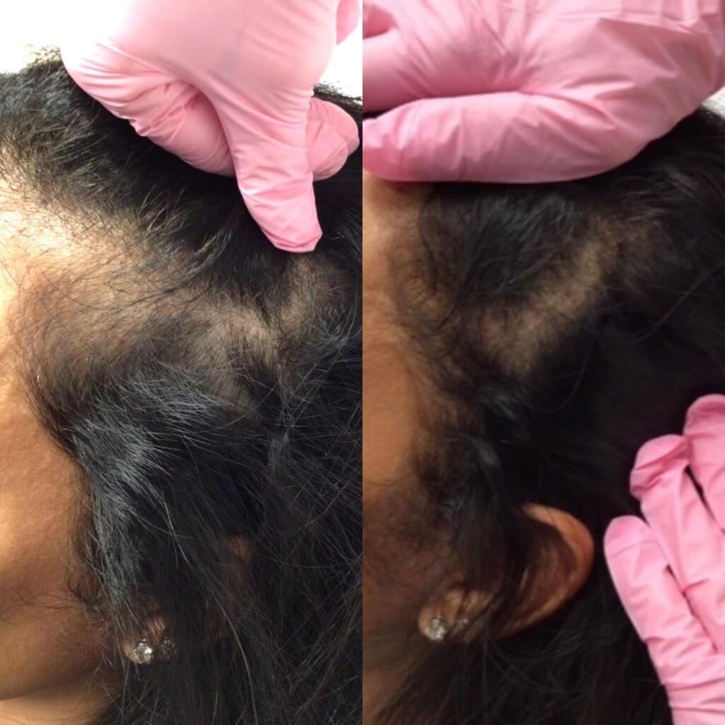 Hair Scalp before and after image Revive Med Spa