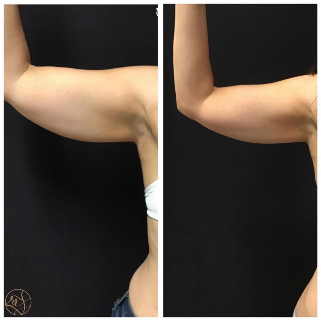 Cool Sculpting on Arms