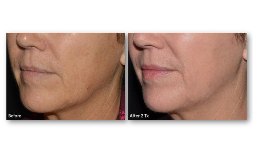 Resurface-Refine-Laser-Facial-Laser-Skin-Services-Revive-Med-Spa-6