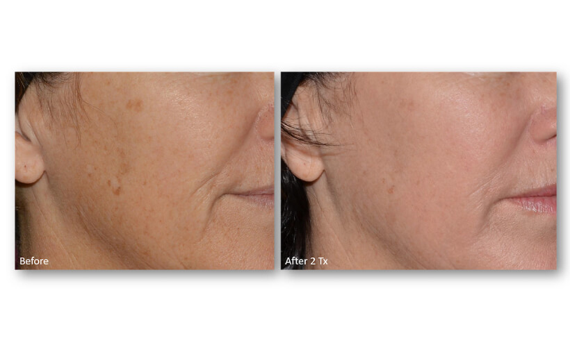 Resurface-Refine-Laser-Facial-Laser-Skin-Services-Revive-Med-Spa-7