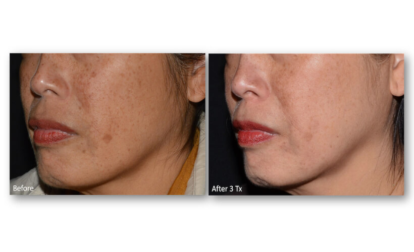 Resurface-Refine-Laser-Facial-Laser-Skin-Services-Revive-Med-Spa-8