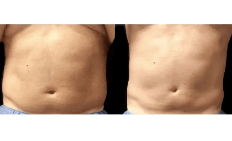 Abdomen-Before-and-After-CoolSculpting-Elite-Revive-Med-Spa-3_edit