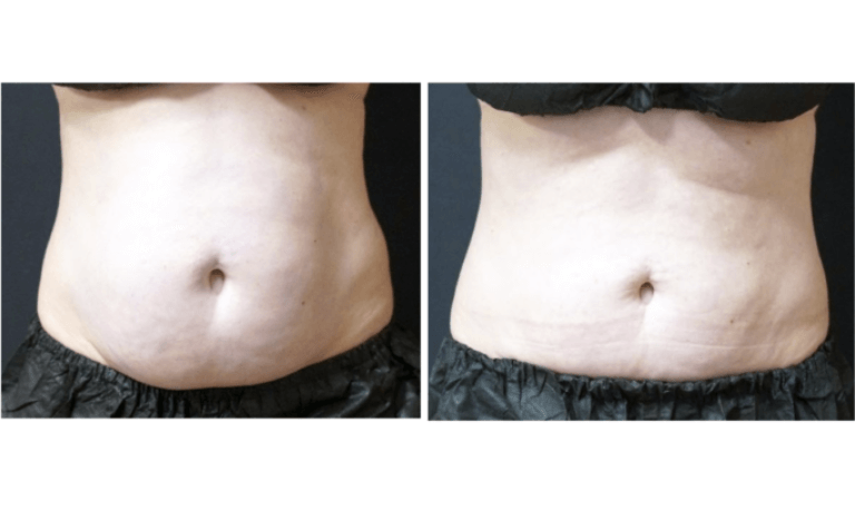 Abdomen-Before-and-After-CoolSculpting-Elite-Revive-Med-Spa-768x372_edit