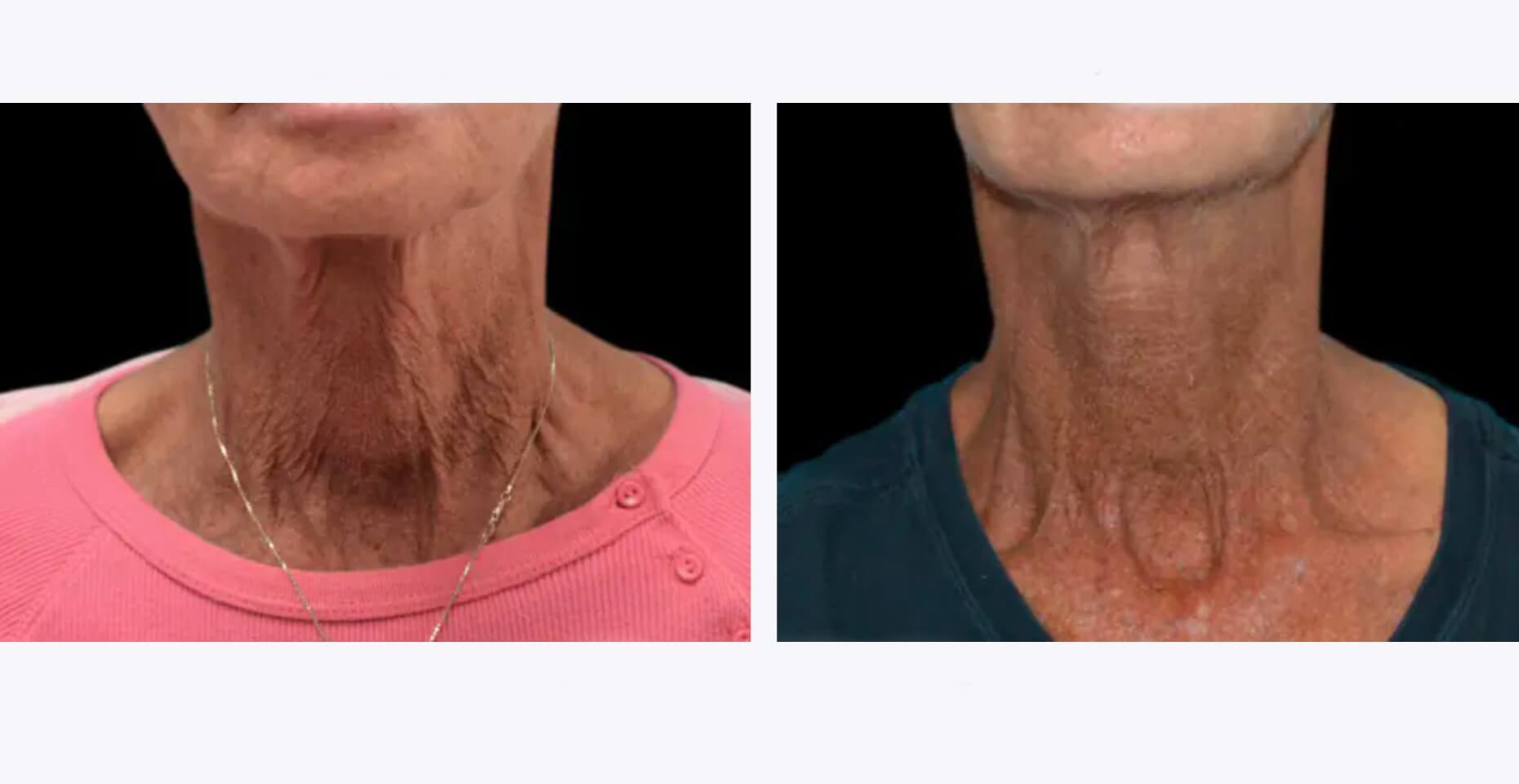 Exilis-Ultra-Treatment-Before-and-After-Revive-Med-Spa-1_edit