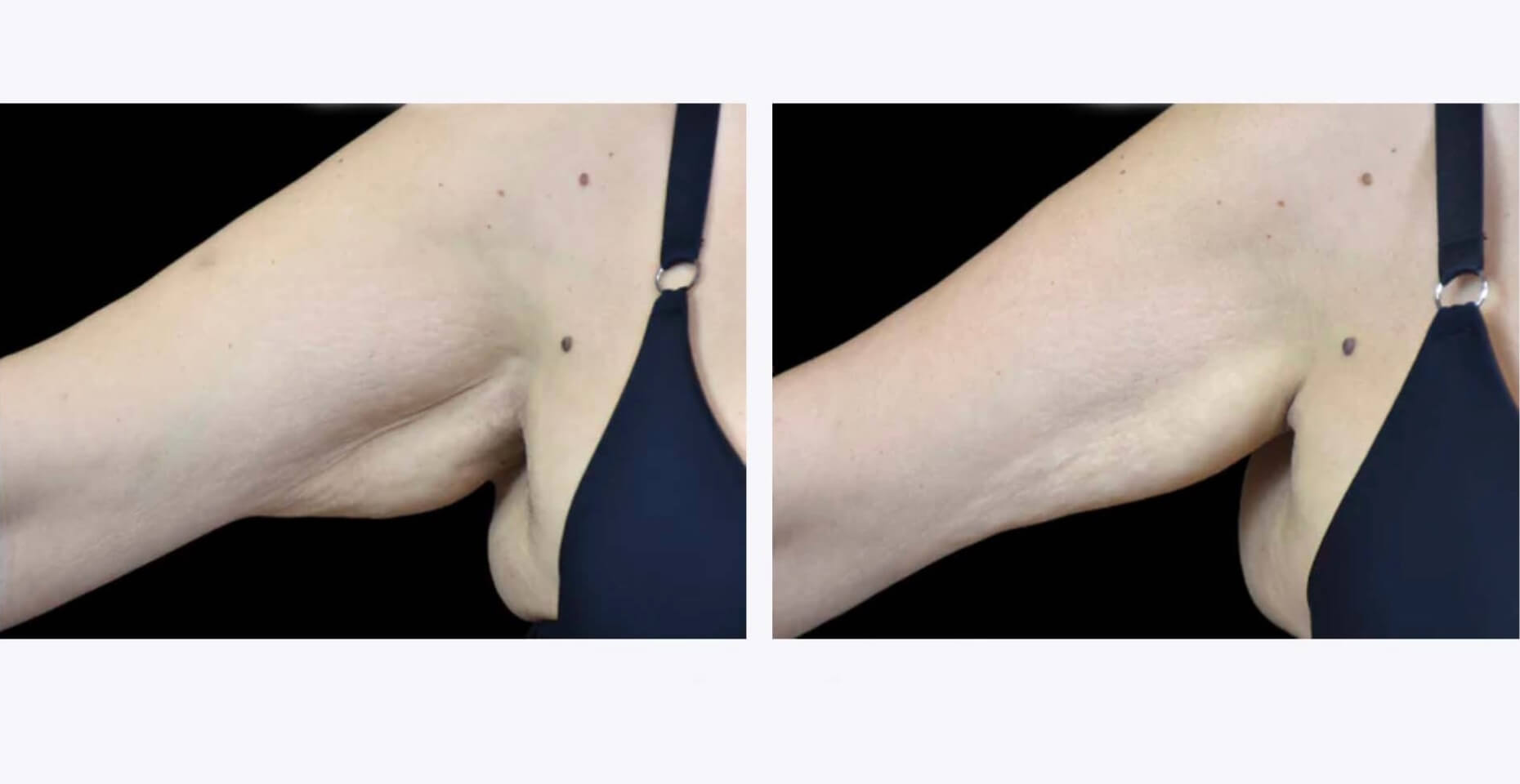 Exilis-Ultra-Treatment-Before-and-After-Revive-Med-Spa-2_edit