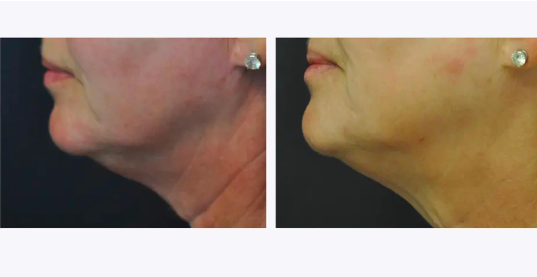 Exilis-Ultra-Treatment-Before-and-After-Revive-Med-Spa_edit