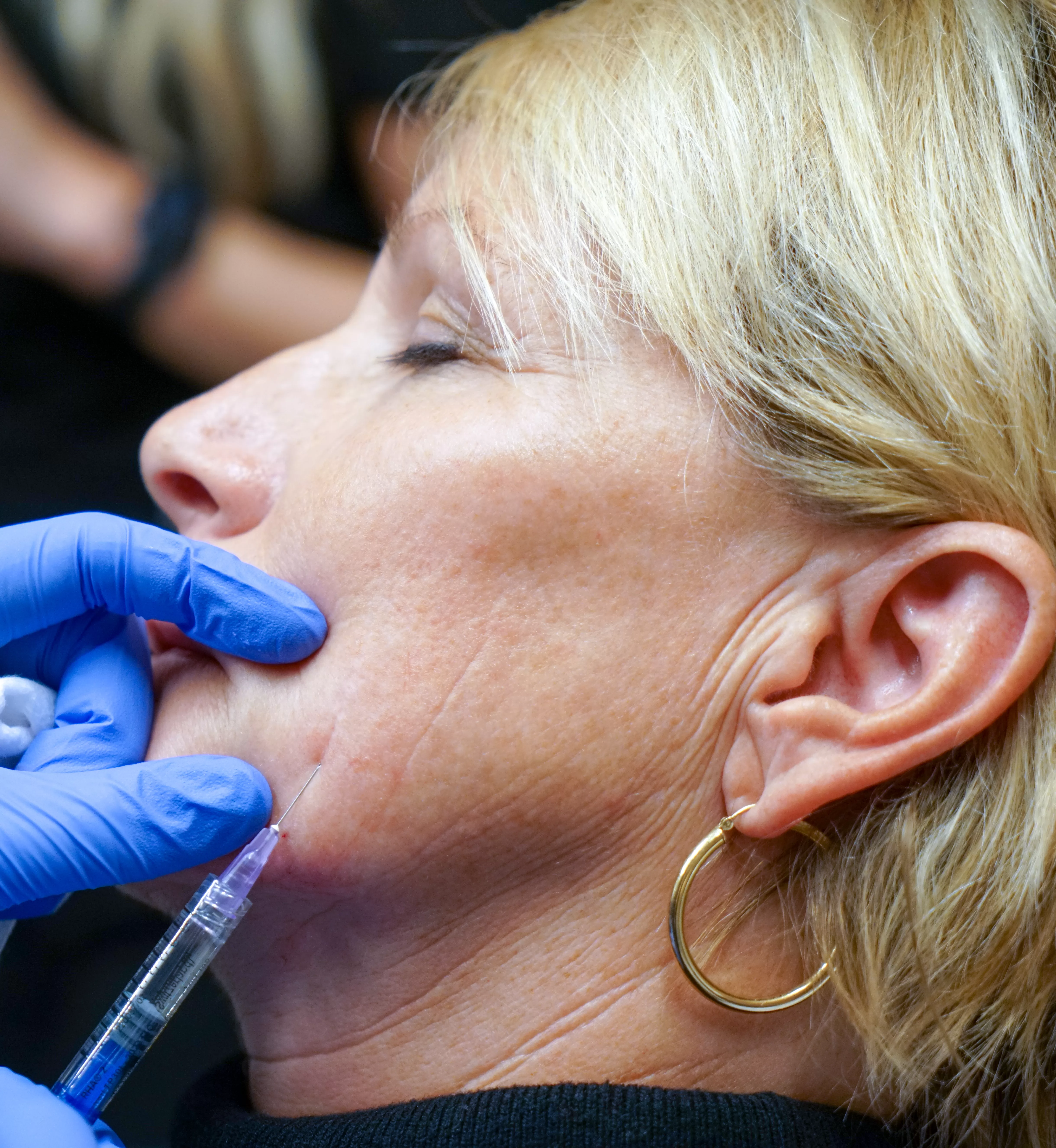 Side shot of woman receiving Juvederm Vollure XC injection in her left cheek above jawline.