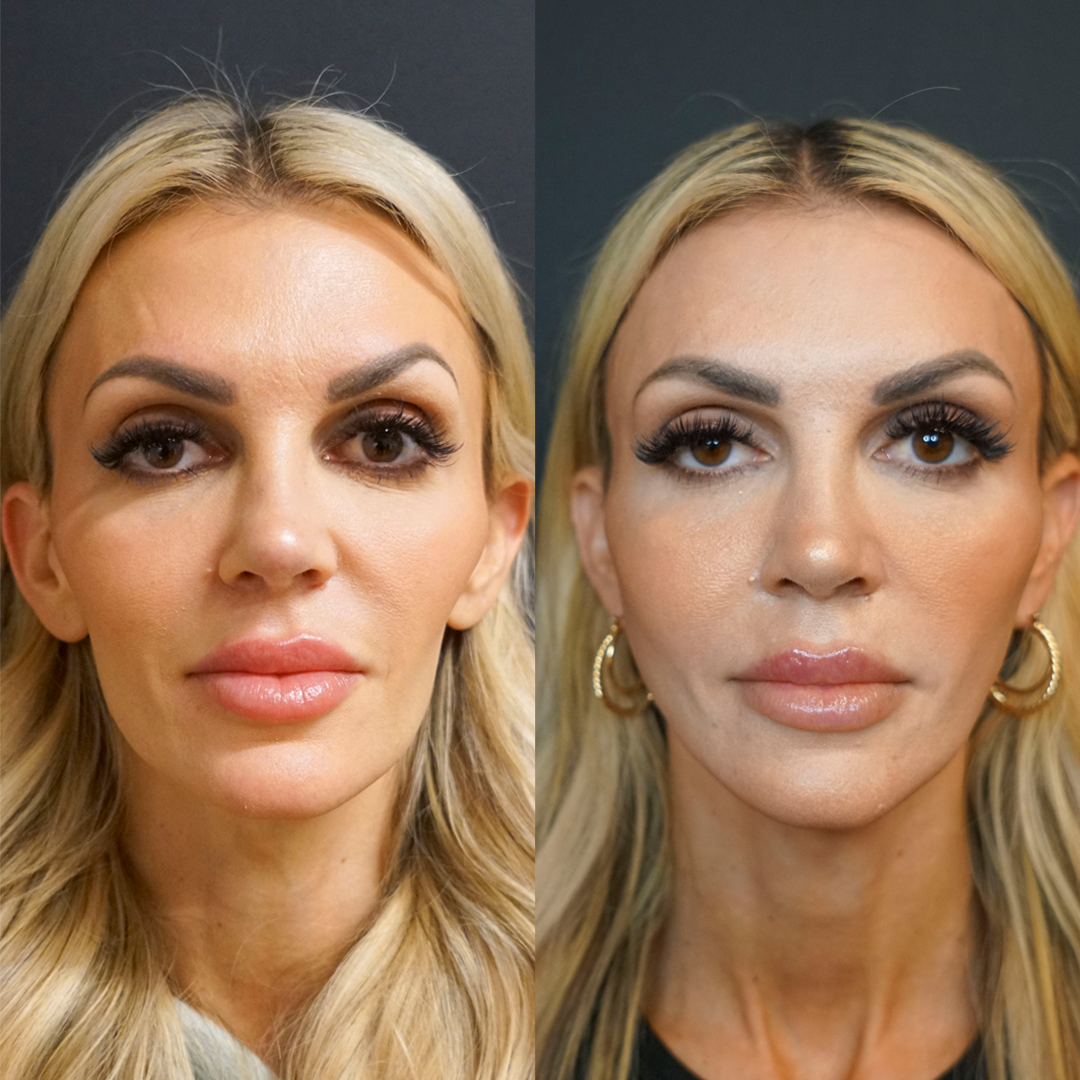 Sculptra Before and After