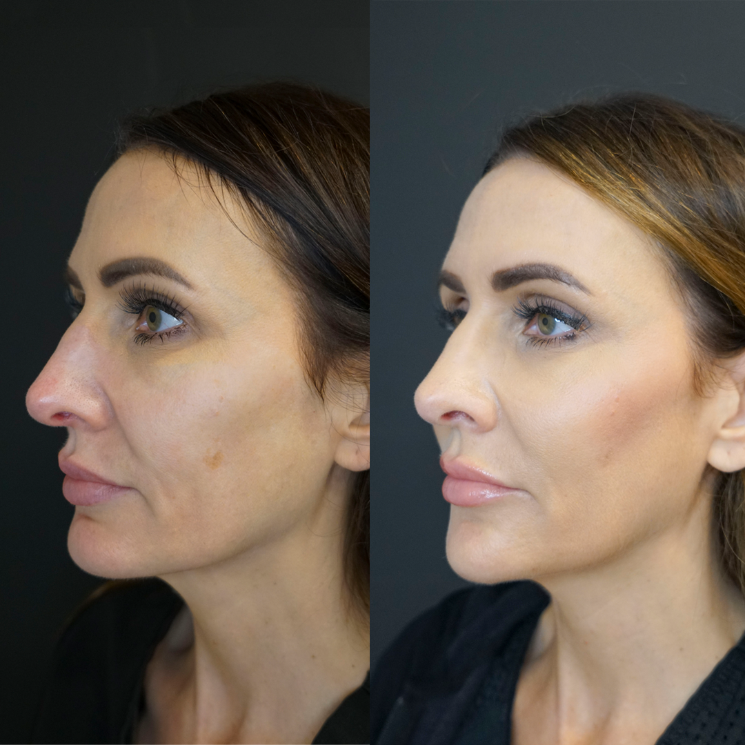 Sculptra Before and After