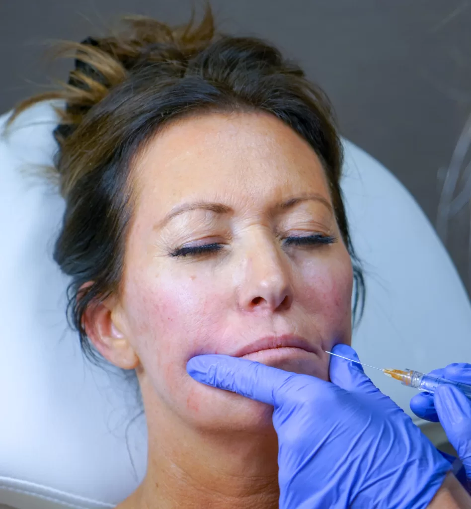 Woman being injected with Juvederm near her upper lip